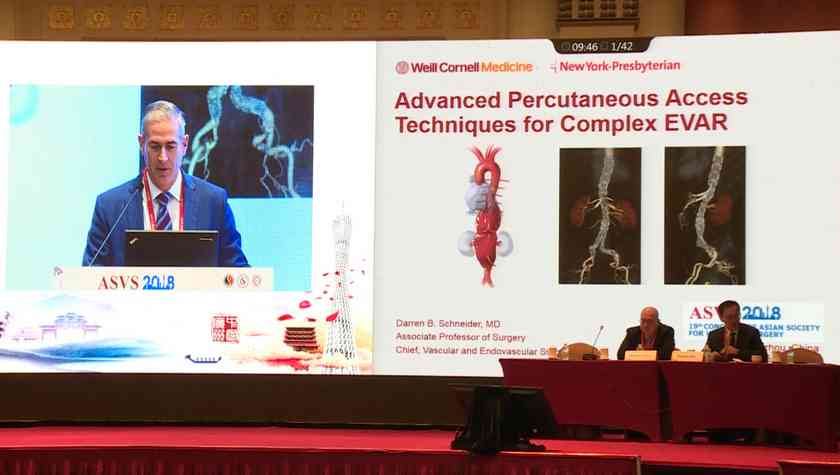 Darren B：Advanced Percutaneous Access Techniques for Complex EVAR